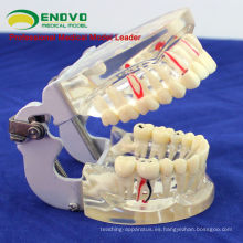 DENTAL07 (12566) Modelo de dientes patológicos adultos transparentes para estudio dental y comunicación